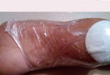 გათავისუფლდით კოჟრისა და დამსკდარი ქუსლებისგან მხოლოდ 10 დღეში! უმარტივესია…