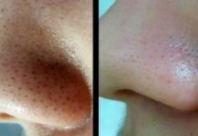 გაისუფთავეთ ფორები უმარტივესად-იდეალური კანი უკვე 7 დღეში!