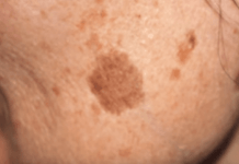 როგორ გავთავისუფლდეთ სწრაფად პიგმენტური ლაქებისგან? ორინგრედიენტიანი რეცეპტი!