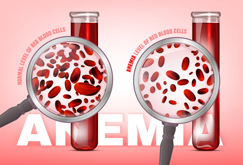 content Iron deficiency anemia
