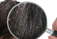 როგორ დავაღწიოთ ქერტლს თავი სწრაფად და გარანტირებულად შინ დამზადებული საშუალებებით