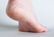 საუკეთესო ბუნებრივი საშუალებები გაუხეშებული ქუსლების სამკურნალოდ