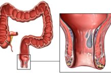 ეს მცენარე ბუასილს ეფექტურად კურნავს!! გაიგეთ მეტი მის შესახებ…