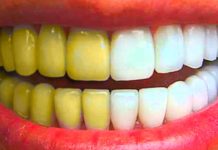 არსებობს საკმაოდ ეფქტური რამდენიმე ხალხური მეთოდი, რომელთა დახმარებით კბილებიდან ქვებს მოიცილებთ და ამავდროულად გაითეთრებთ