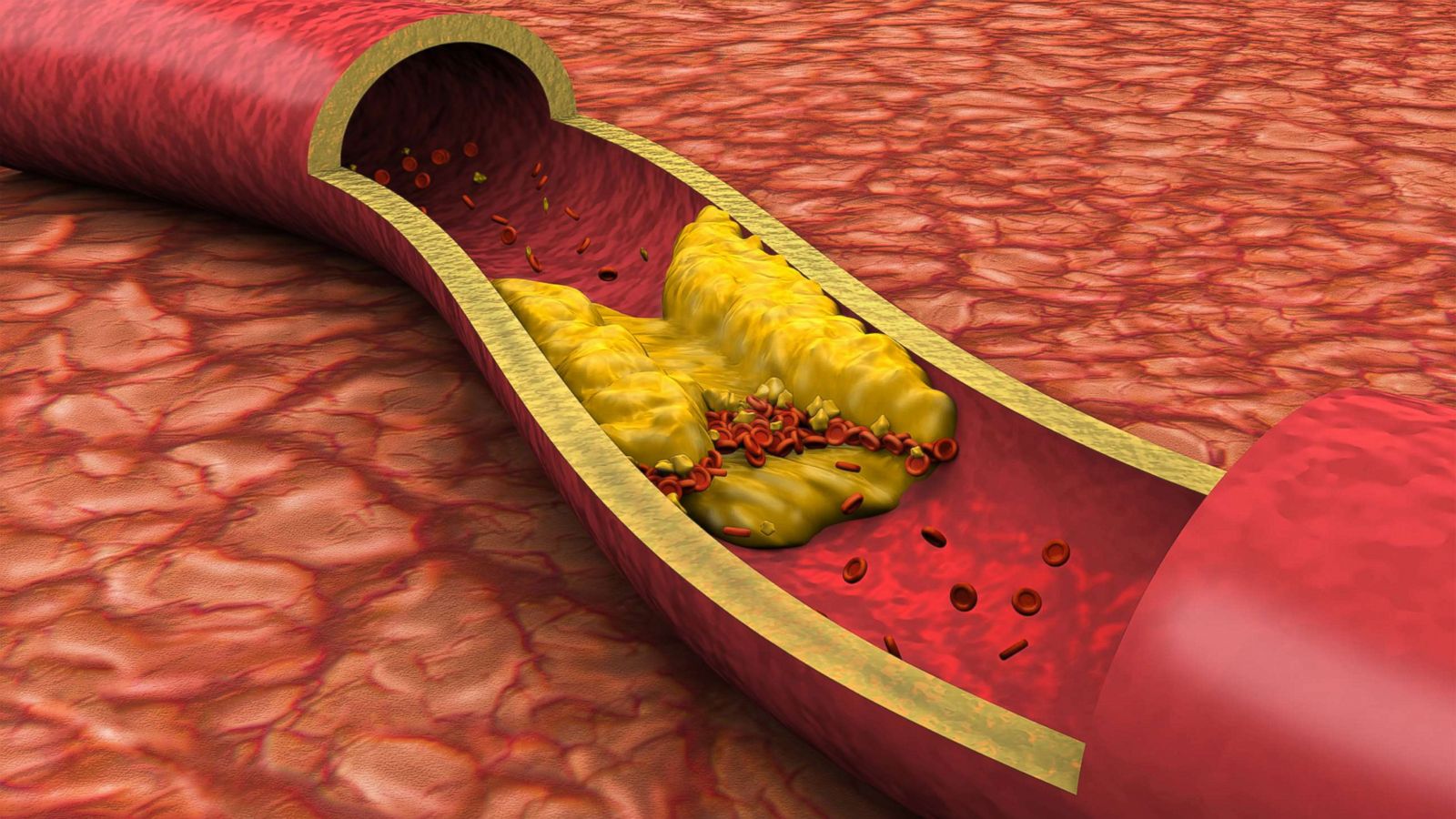 cholesterol illustration rf gty jc