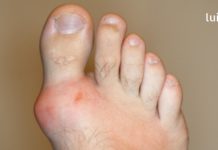 ხალხური უძლიერესი საშუალება, რომელიც პოდაგრის სამუდამოდ მოშორებაში დაგეხმარებათ!