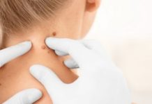 როგორ მოვიშოროთ ვირუსული მეჭეჭები ბუნებრივი გზით?