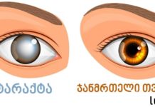 კატარაქტა: სიმპტომები, მიზეზები და მკურნალობა