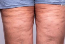 თვალსაჩინო მიზეზები იმისა, რომ თქვენს ორგანიზმს აწუხებს ჭარბი სითხის შეკავების პრობლემა!!