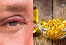 ბლეფარიტი: რა სიმპტომები ახასიათებს მას და როგორ უნდა ვუმკურნალოთ ოჯახურ პირობებში?