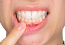 ღრძილის რეტრაქციას ეს 4 ინგრედიენტი შველის! რთული პრობლემის მარტივი გადაწყვეტა!