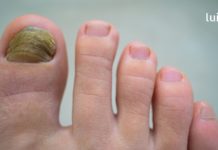 ამ სასწაულებრივი ნარევის დახმარებით სოკო ფრჩხილებზე ერთხელ და სამუდამოდ ქრება..