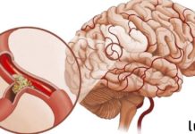 მაღალი წნევა და ხმაური თავის არეში: სისხლძარღვებს წამლების გარეშე ვუბრუნებთ ელასტიურობას