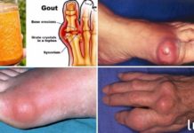 ხალხური ძლიერი საშუალება პოდაგრისგან სამუდამოდ მოსაშორებლად!