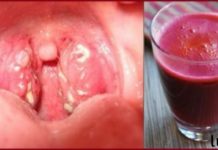 როგორ მოვიშოროთ ყელის ინფექციები ბუნებრივად სულ რაღაც 4 საათში!! წარმოუდგენლად სასარგებლო!