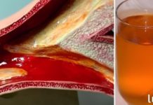 კინაღამ მოვკვდი გულის შეტევით დახშული არტერიების გამო, მაგრამ ეს სასმელი დამეხმარა მათ გაწმენდაში!