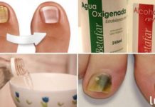 ფრჩხილის სოკო სამუდამოდ გაქრება ამ ხალხური საშუალების გამოყენების შემდეგ!