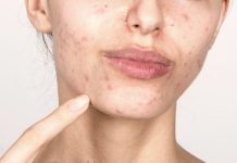 არ გამოიყენო ეს 5 პროდუქტი, თუ აკნეს მოშორება გინდა!