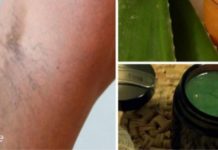 ბებიას რეცეპტი ვარიკოზისთვის: შედეგი ძალიან მალე! ვარიკოზული ვენების