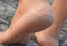 ფეხების სიმშრალე გავრცელებული პრობლემაა. გთავაზობთ 8 ყველაზე ეფექტურ რეცეპტს ამ პრობლემის დასამარცხებლად!