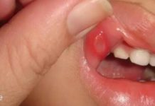 მე და ჩემს შვილს გვაწუხებდა სტომატიტი, აი როგორ ვუმკურნალეთ მას