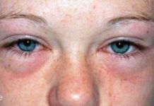 ალერგია, მისი გამომწვევი მიზეზები და მკურნალობა ხალხური მეთოდით.