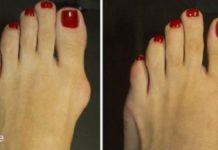 პოდაგრა არ არის მხოლოდ ფეხის თითის დაზიანება – გაიგეთ როგორ უმკურნალოთ მას!
