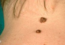 როგორ მოვიშოროთ პაპილომები კანზე ხალხური მედიცინის დახმარებით?