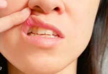 პირის ღრუს სტომატიტი: აი, როგორ მოვიშოროთ იგი ხალხური მეთოდით წუთებში, ყოველგვარი მედიკამენტების გარეშე!