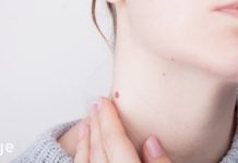 მეჭეჭებისა და კანის პაპილომების მოსაცილებელი საშუალებები: მარტივი, უმტკივნეულო და ბიუჯეტური!