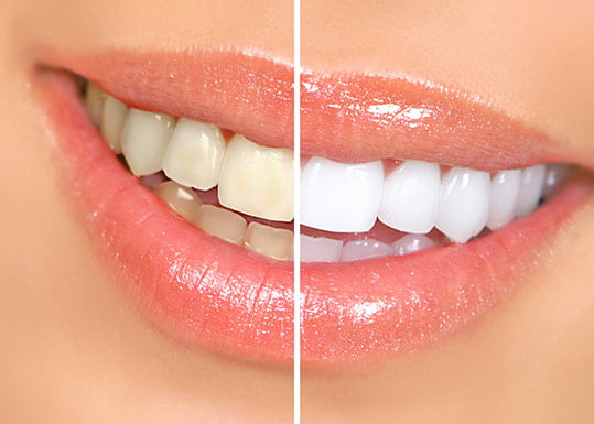 teeth whitening healdsbury dental spa