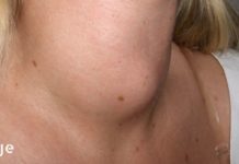 ექიმები ამას არასოდეს გეტყვიან! – აი, როგორ განიკურნოთ ფარისებრი ჯირკვალი მხოლოდ ერთი ინგრედიენტით!ა