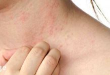 მნიშვნელოვანია იცოდეთ! ეს სიმპტომები განიშნებთ რომ შესაძლოა სისხლში მაღალი შაქრის დონე გქონდეთ!