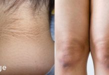 დიაბეტის ადრეული ნიშნები, რომელთა შესახებაც პროფესიონალი ექიმების უმეტესობამ არც კი იცის!