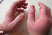 თუ შეამჩნევთ ამ სიმპტომებს, დაუყოვნებლივ შეიმოწმეთ თირკმელები!