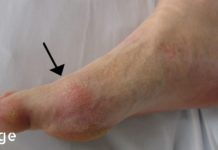 პოდაგრა? მოერიდეთ ამ 5 საკვებს, რომელიც აუარესებს მდგომარეობას!