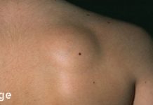 როგორ ვუმკურნალოთ კანის გამონაყარს, რომელიც ცნობილია როგორც ლიპომა? 100% ნატურალური რეცეპტები!