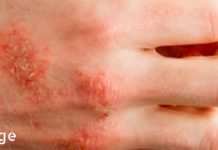 აი როგორ უმკურნალა დედაჩემმა უსაფრთხო, ბუნებრივი და ეფექტური გზით ეგზემას!