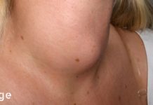 ჰიპერთირეოზის 5 მიზეზი და რა უნდა იცოდეთ მასზე აუცილებლად! ჰიპერთირეოზის 5 მიზეზი და რა უნდა იცოდეთ მასზე აუცილებლად!