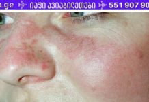 12 პროდუქტი, რომელიც ხელს შეუწყობს მგლურას წინააღმდეგ ბრძოლას და ტკივილის შემსუბუქებას!