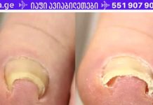 4 საშუალება დაზიანებული ფრჩხილების მკურნალობისთვის სახლის პირობებში!