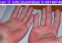 ხელები ხშირად გიბუჟდება ხოლმე?! 7 მიზეზი, რომელიც დაგაფიქრებს!