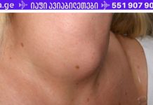 ფარისებრი ჯირკვლის დეფექტები – სიმპტომები და სამკურნალო ბუნებრივი საშუალებები! farisebri jirkvali