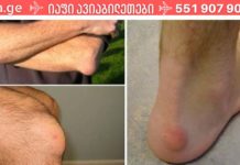 სამკურნალო მცენარეები, რომლებიც ხელს უწყობენ ძვლოვანი წამონაზარდის გაქრობას!