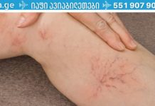 სამუდამოდ მოიშორეთ ვარიკოზული ვენები ერთი მარტივი ინგრედიენტით!