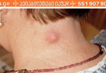 კისტა კისერზე ან ყურის უკან – რა არის და როგორ მოვიშოროთ იგი?