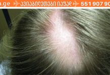 თმის ცვენა ქალებში: მიზეზები, მკურნალობა და პრევენციის გზები!