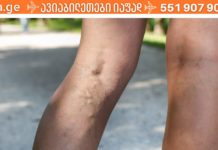 7 წესი, რომელიც უნდა დაიცვათ, თუ გსურთ განკურნოთ ვარიკოზული ვენები!