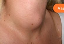 ფარისებრი ჯირკვლის პრობლემების 10 ყველაზე გავრცელებული სიმპტომი! იყვაით ყურადღებით!