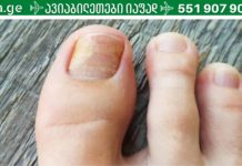 ფრჩხილის სოკოს მოსაშორებლად ერთ-ერთი საუკეთესო ხალხური საშუალება!